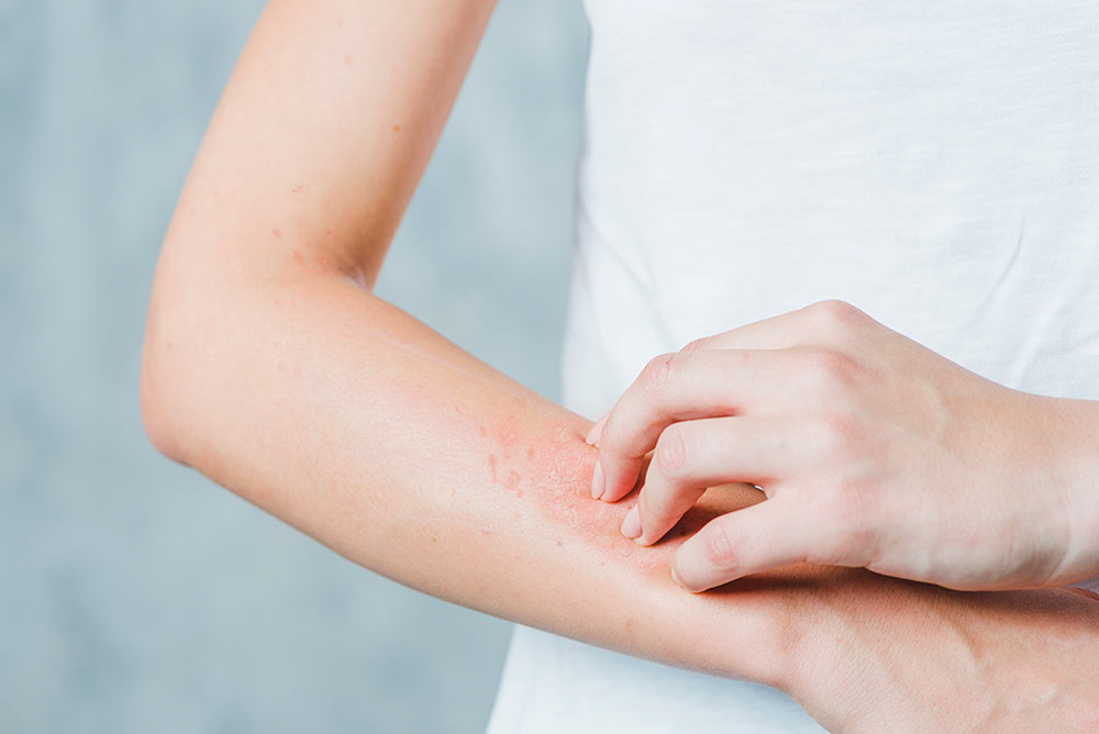 tiips til psoriasis forebyggelse